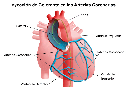 Angiografía coronaria | Todo lo que quieres saber cabg diagram 
